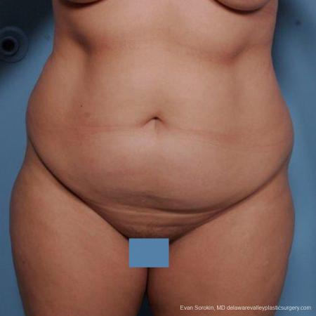 Philadelphia Liposuction 9481 - Before Image 1