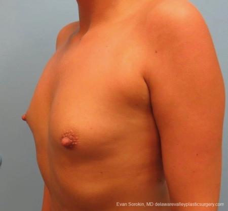 Philadelphia Breast Augmentation 8826 - Before and After Image 5