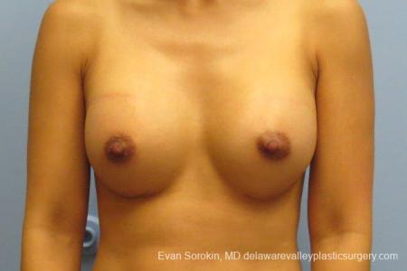 Philadelphia Breast Augmentation 8661 - After Image 1