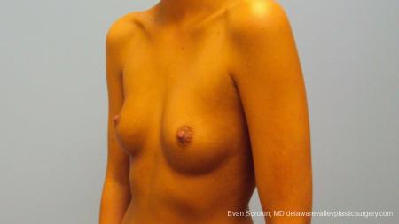 Philadelphia Breast Augmentation 9292 - Before Image 3