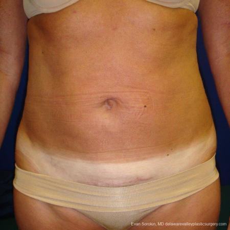 Philadelphia Liposuction 9488 - After Image 1