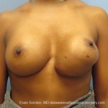 Philadelphia Breast Augmentation 8653 - Before Image 1