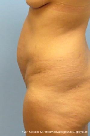 Philadelphia Abdominoplasty 8825 - Before and After Image 3