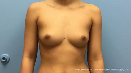 Philadelphia Breast Augmentation 13183 - Before Image 1