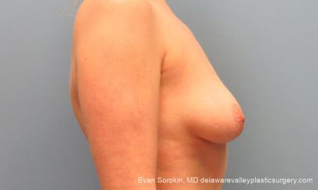 Philadelphia Breast Lift and Augmentation 10116 - Before Image 3