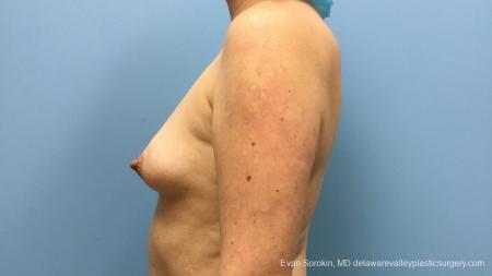 Philadelphia Breast Augmentation 13181 - Before and After Image 5