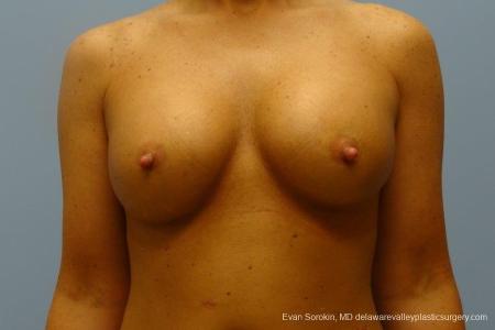 Philadelphia Breast Augmentation 8774 - After Image 1