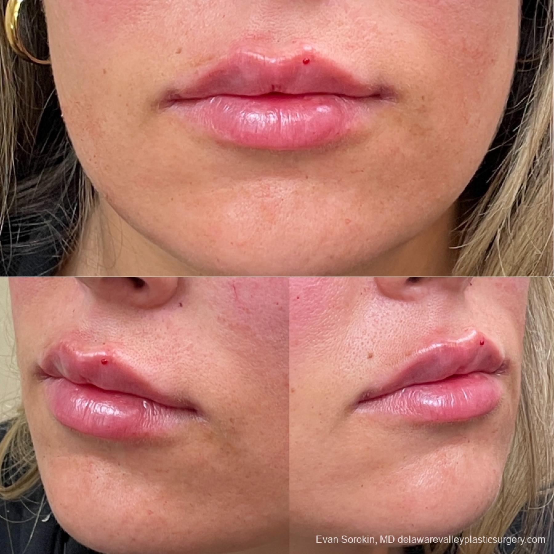 Lip Filler: Patient 37 - Before and After 3