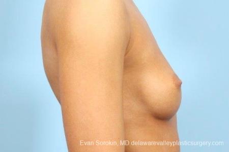 Philadelphia Breast Augmentation 8769 - Before Image 4