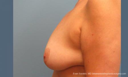 Philadelphia Breast Lift and Augmentation 9431 - Before and After Image 5