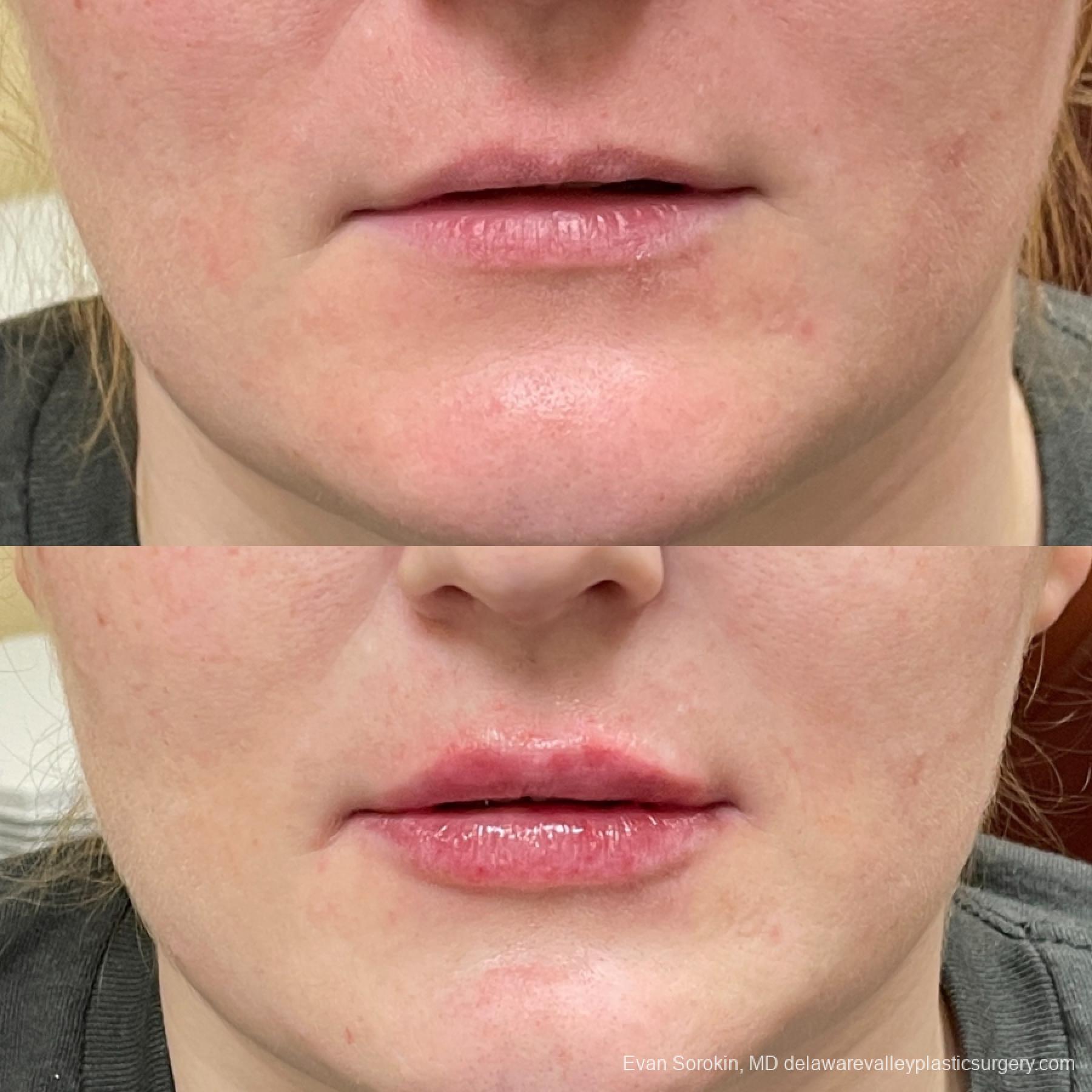 Lip Augmentation: Patient 14 - Before and After 