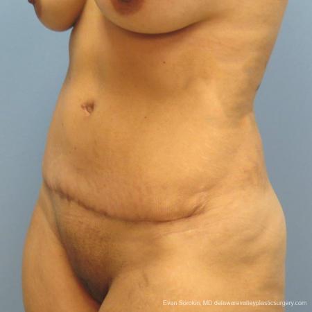 Philadelphia Abdominoplasty 9478 - After Image 2
