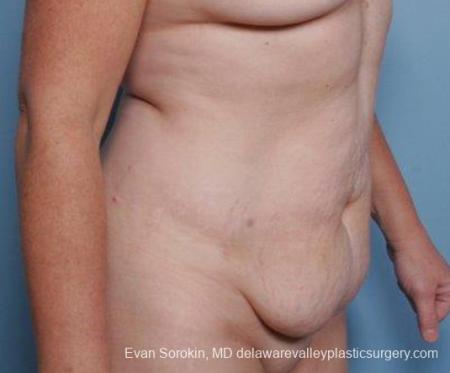 Philadelphia Abdominoplasty 9315 - Before Image 4