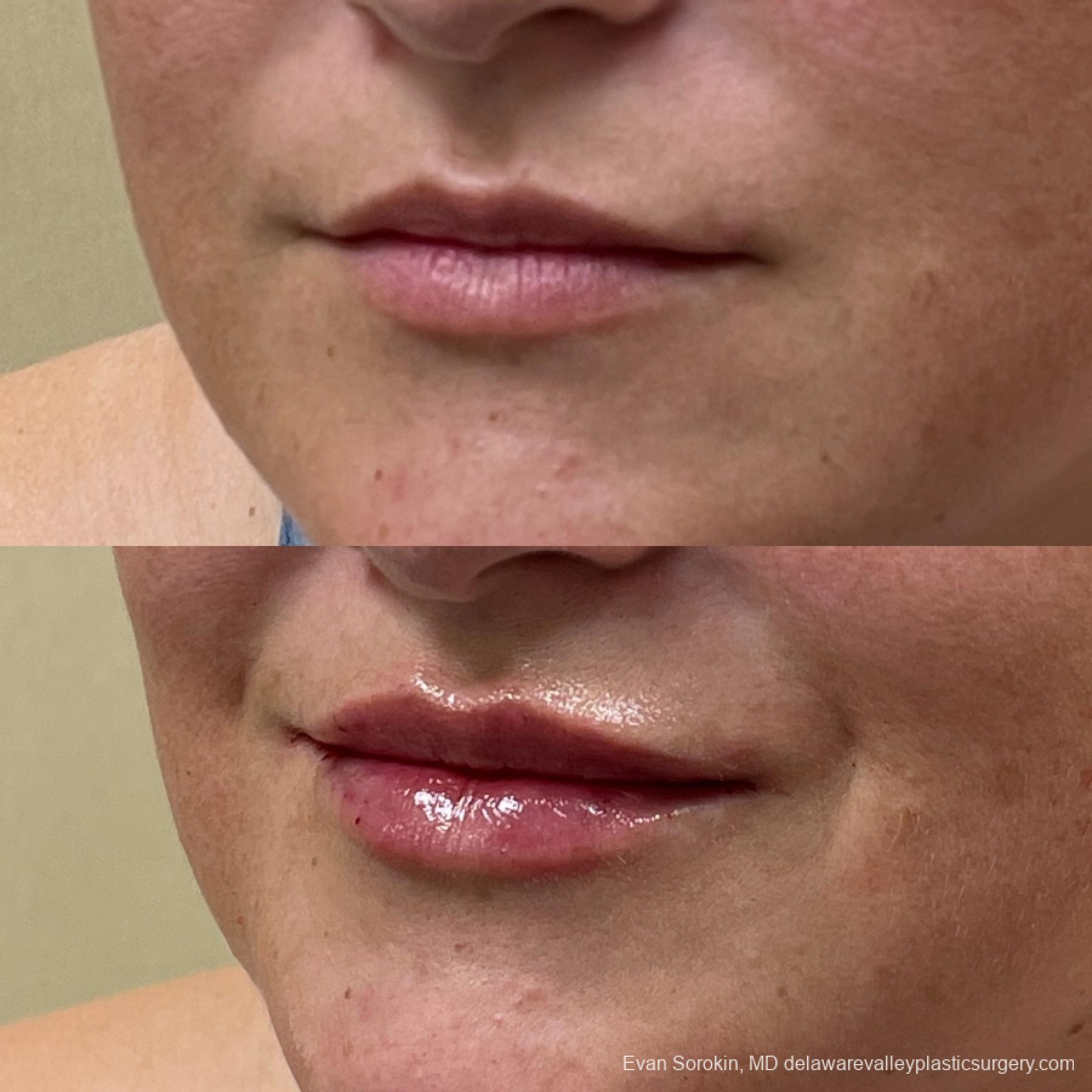 Lip Augmentation: Patient 16 - Before and After 3