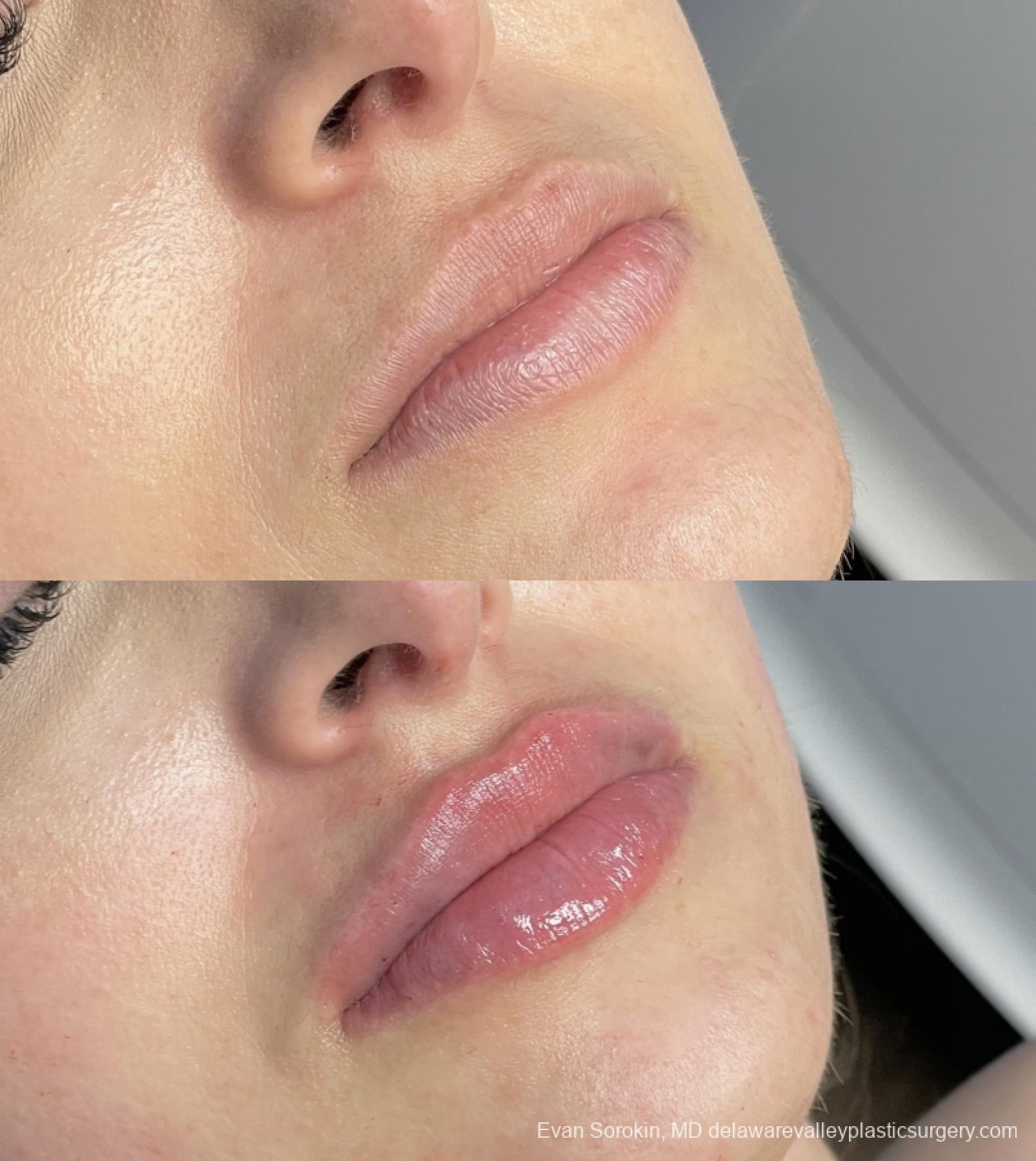 Lip Augmentation: Patient 57 - Before and After 2