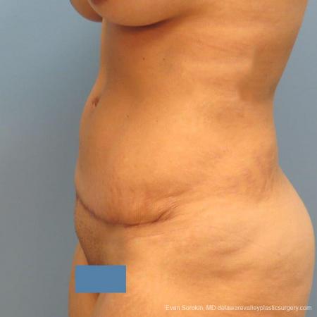 Philadelphia Abdominoplasty 9478 - After Image 3