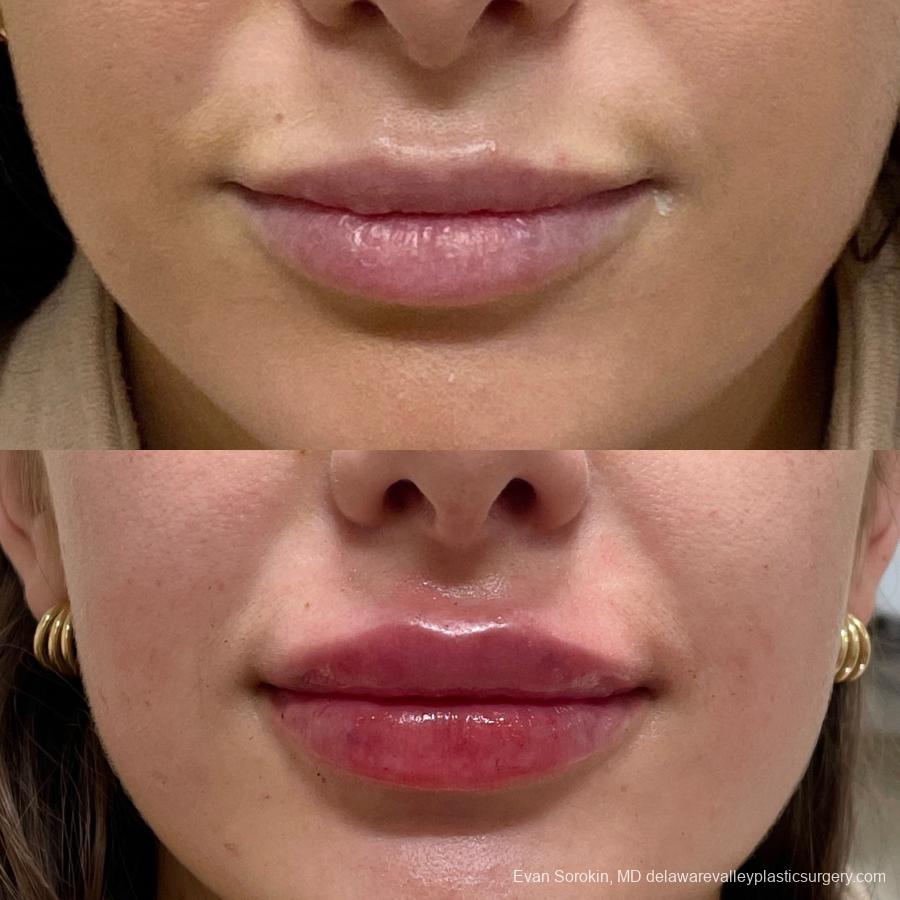 Lip Augmentation: Patient 29 - Before and After 1