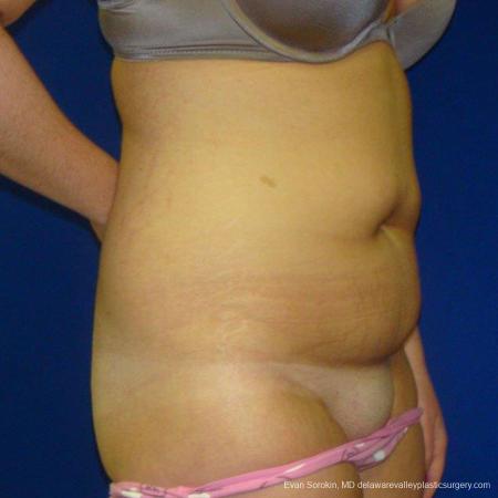 Philadelphia Liposuction 9484 - Before Image 2