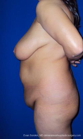 Philadelphia Mommy Makeover 9469 - Before and After Image 5