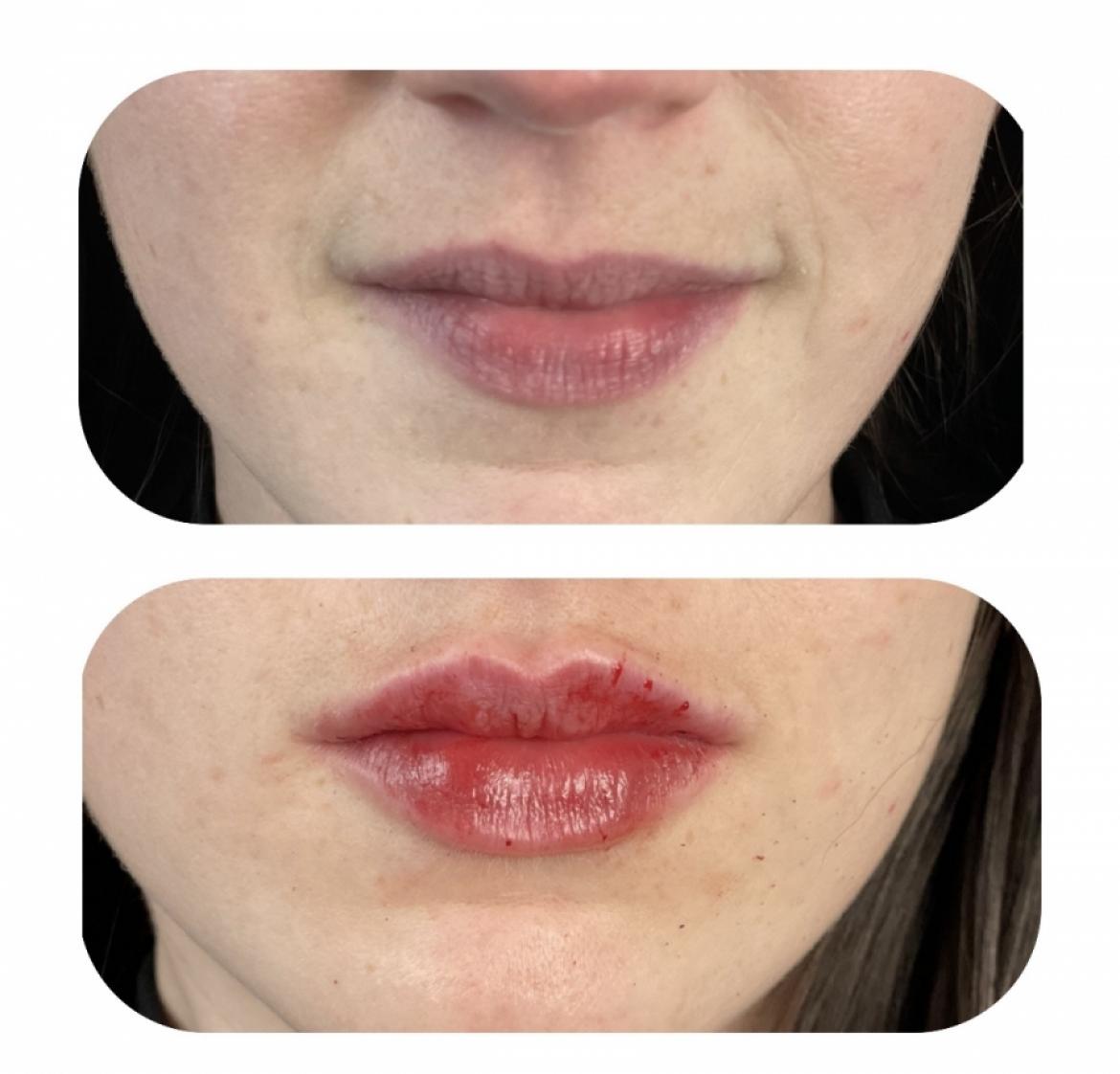 Lip Augmentation: Patient 43 - Before and After 1