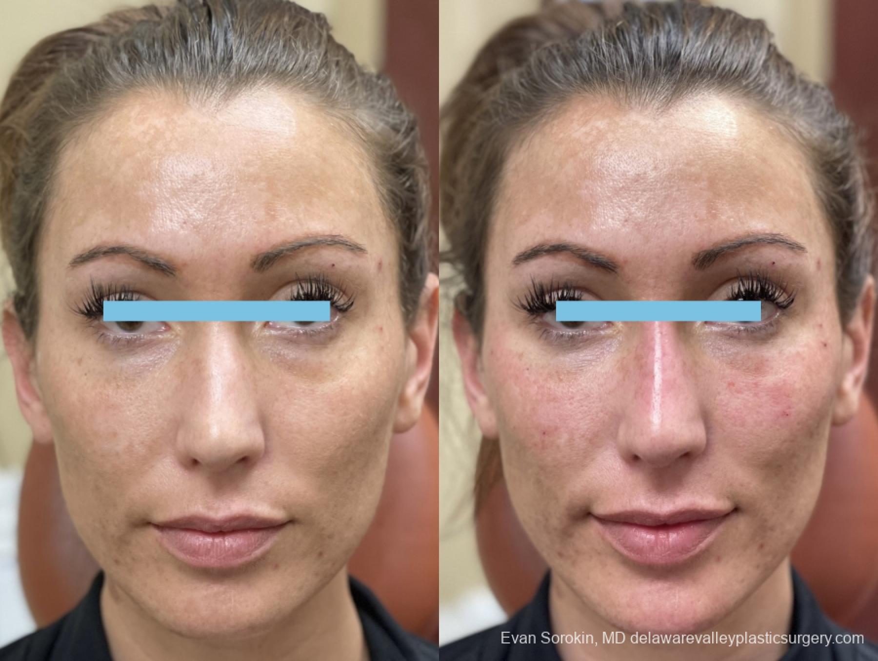 Fillers: Patient 12 - Before and After 