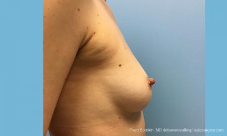 Philadelphia Breast Augmentation 12514 - Before Image 4