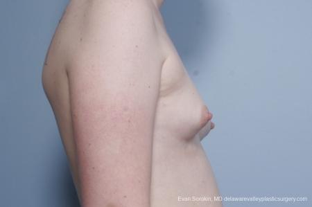 Philadelphia Top Surgery Male to Female 8642 - Before Image 4