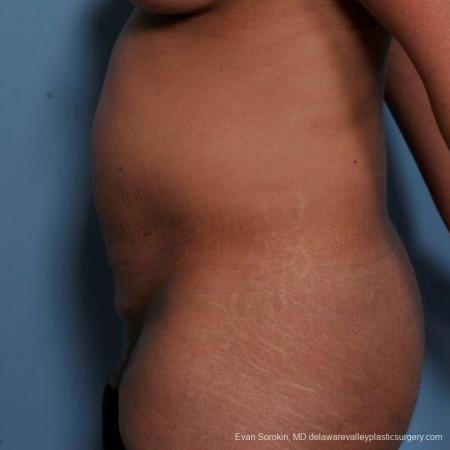 Philadelphia Abdominoplasty 9479 - Before and After Image 5