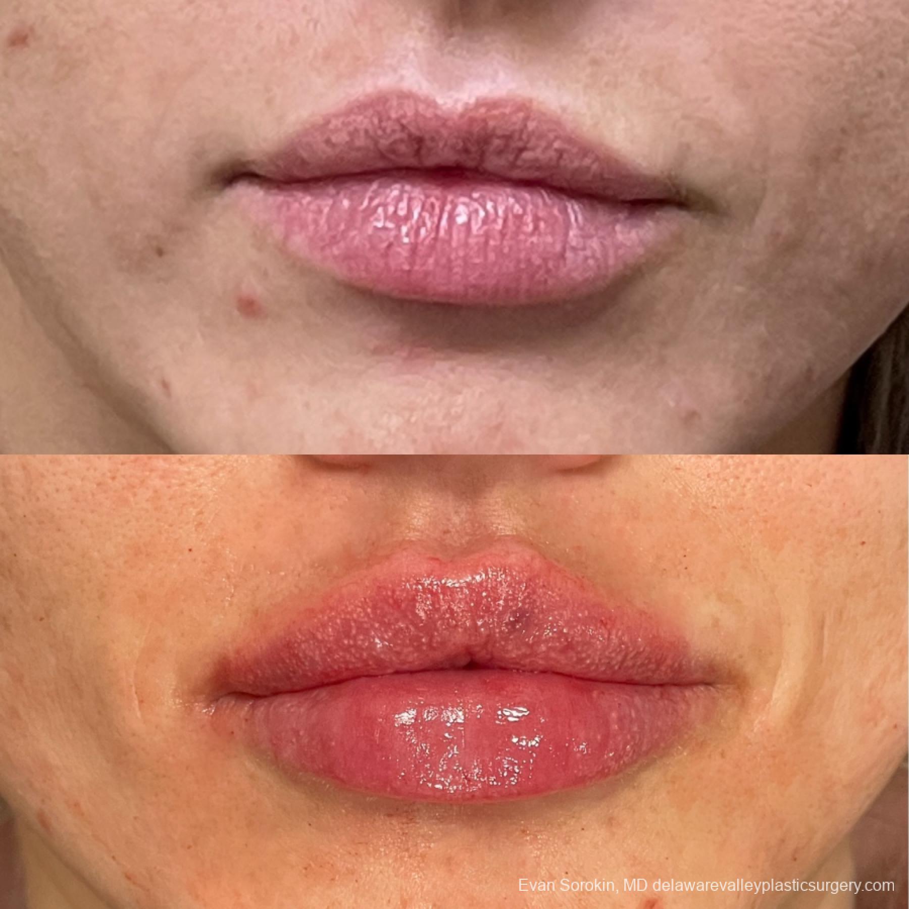 Lip Augmentation: Patient 58 - Before and After 1