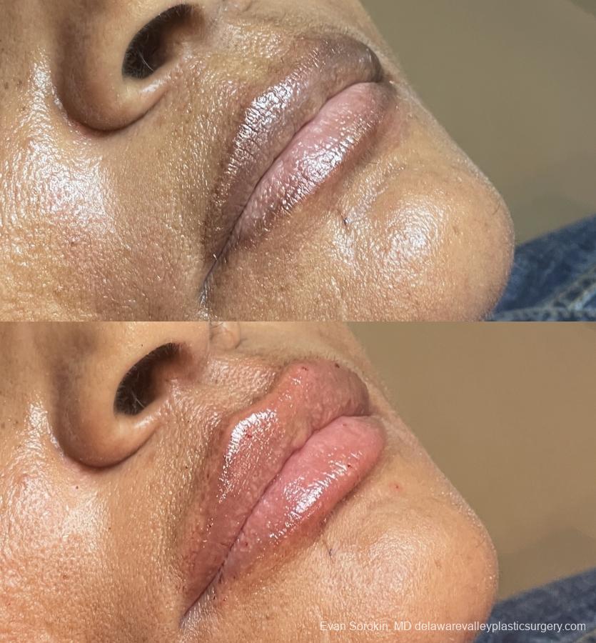 Lip Filler: Patient 48 - Before and After 2