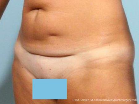 Philadelphia Abdominoplasty 9464 - Before Image 4