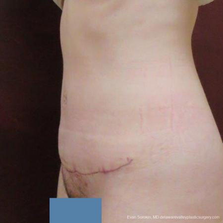 Philadelphia Abdominoplasty 9465 - After Image 4