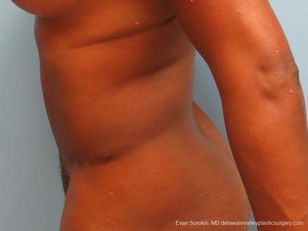 Philadelphia Abdominoplasty 9339 - After Image 5