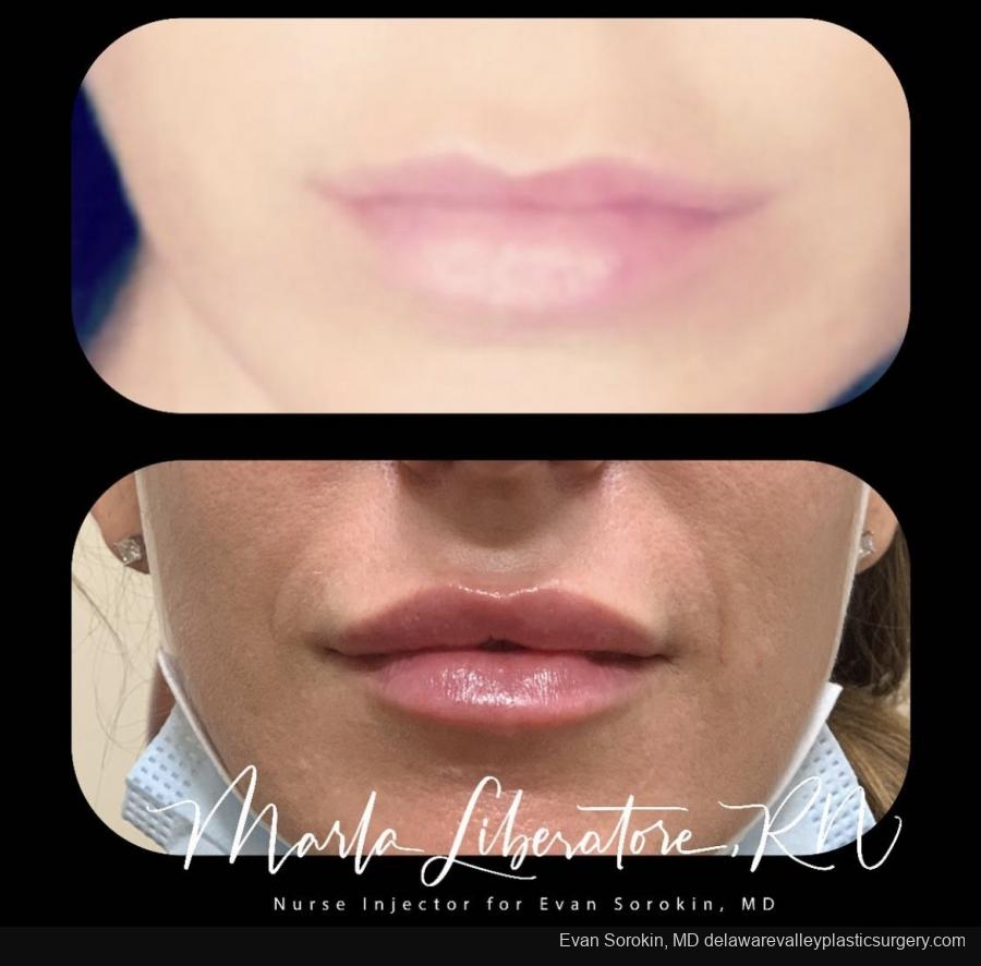 Lip Augmentation: Patient 15 - Before and After Image 1