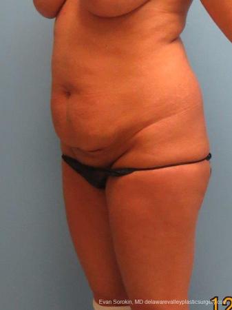 Philadelphia Abdominoplasty 9463 - Before Image 4
