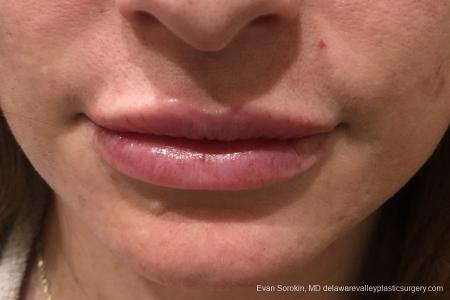 Lip Filler: Patient 12 - After Image 1