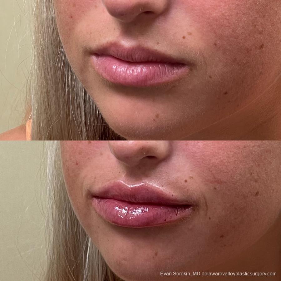 Lip Filler: Patient 27 - Before and After 3