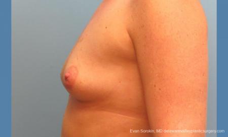 Philadelphia Breast Augmentation 9487 - Before and After Image 5