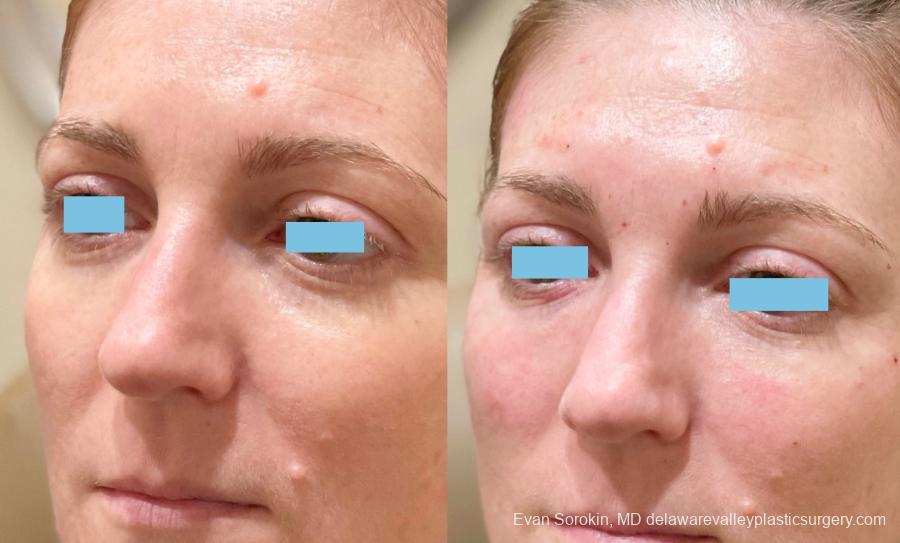 Fillers: Patient 15 - Before and After 2