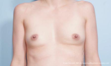 Philadelphia Breast Augmentation 9175 - Before Image 1