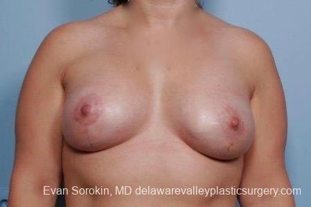 Philadelphia Breast Lift and Augmentation 8702 -  After 1