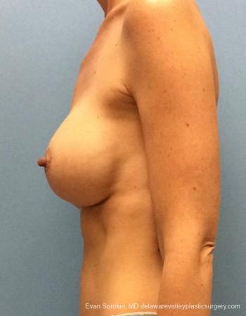 Philadelphia Breast Augmentation 13069 - Before and After 5