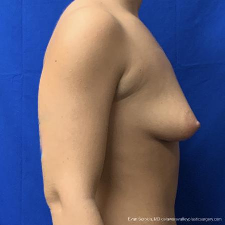Breast Lift And Augmentation: Patient 43 - Before and After Image 3