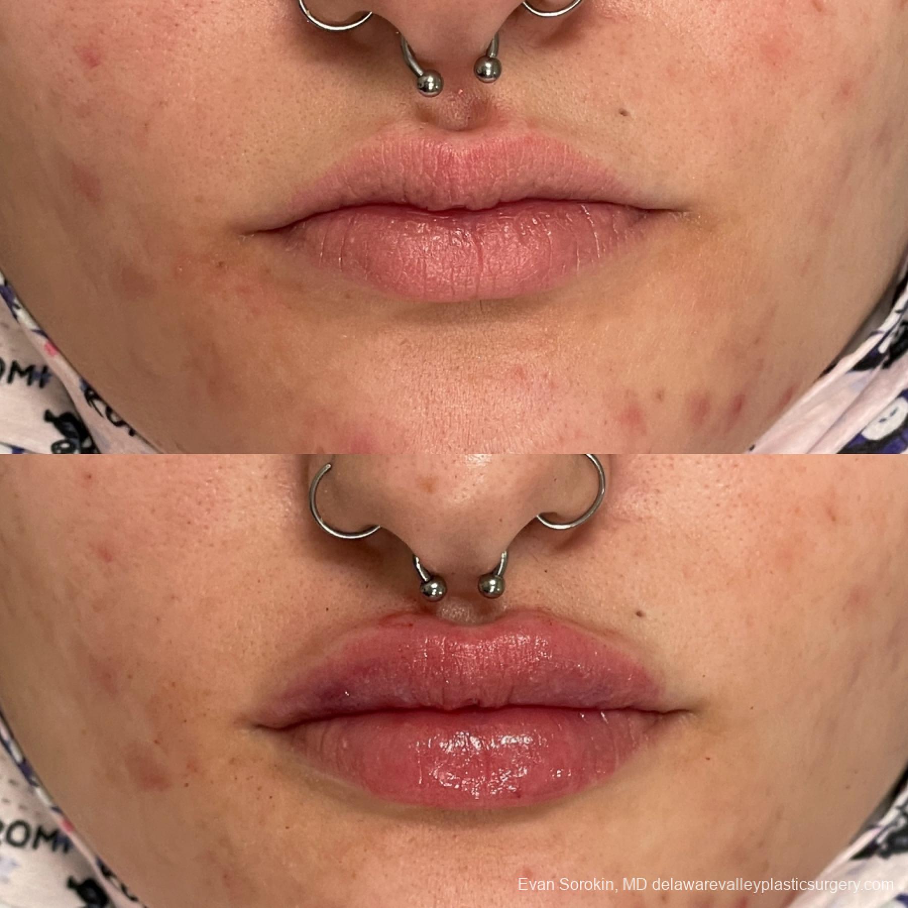 Lip Filler: Patient 20 - Before and After 1