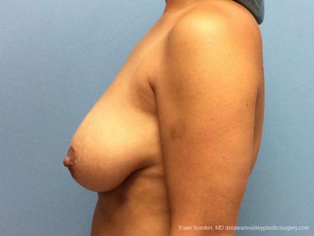 Philadelphia Breast Lift and Augmentation 13070 - Before and After Image 5