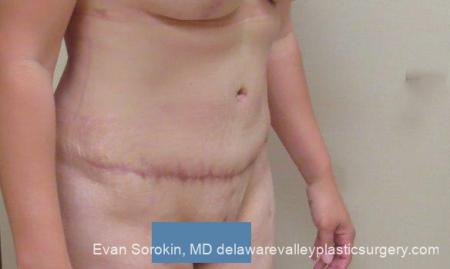 Philadelphia Abdominoplasty 10122 - After Image 2