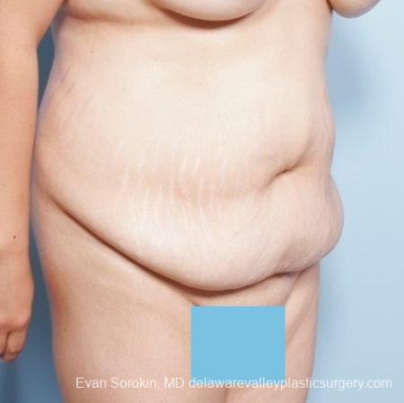 Philadelphia Abdominoplasty 8678 - Before and After Image 5