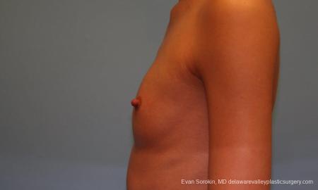 Philadelphia Breast Augmentation 9377 - Before and After Image 5