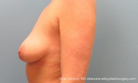Philadelphia Breast Lift and Augmentation 10116 - Before and After Image 5
