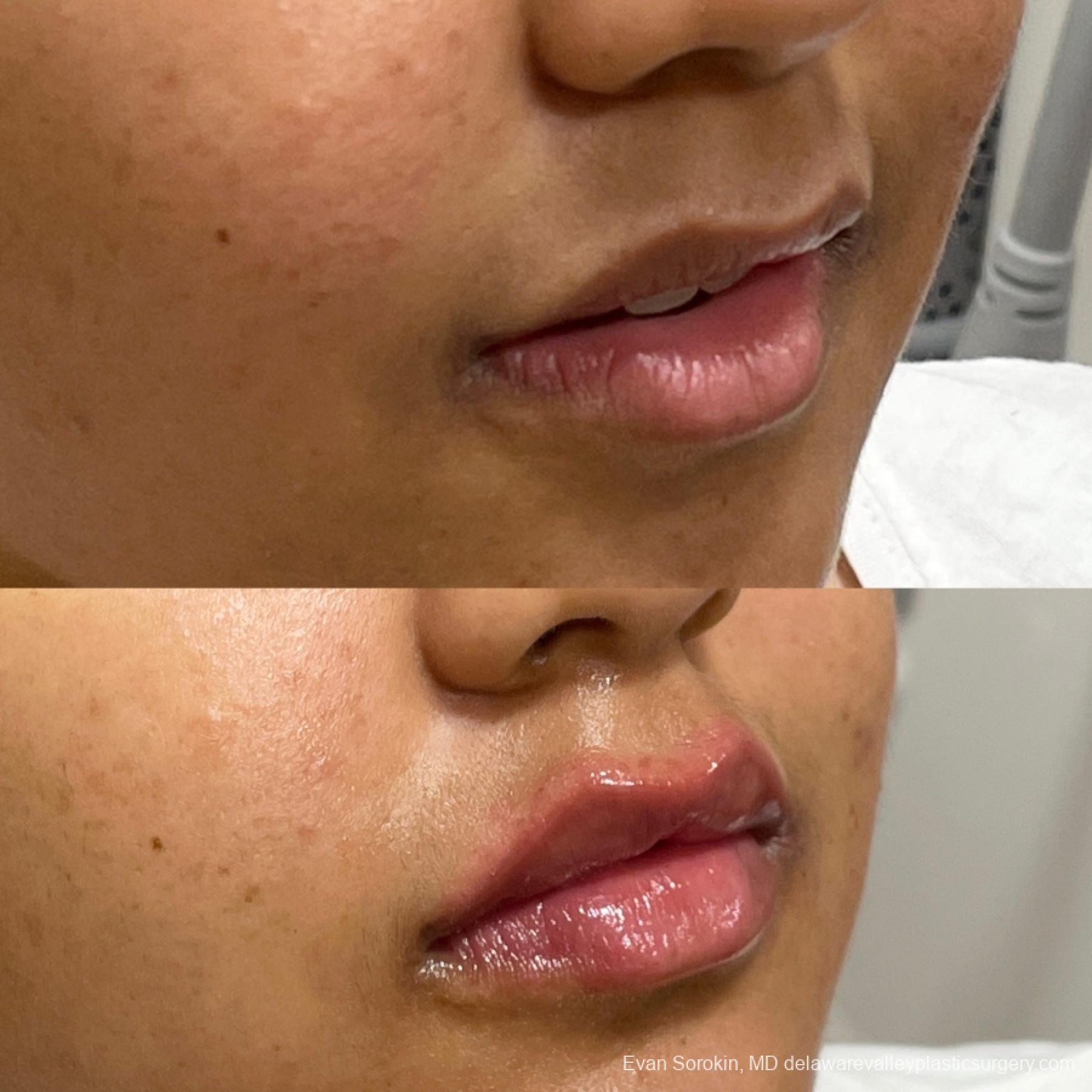Lip Filler: Patient 10 - Before and After 2